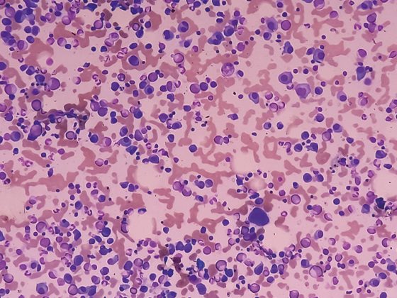 multiplesmyelom_istock-1414749071