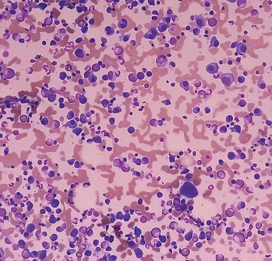 multiplesmyelom_istock-1414749071