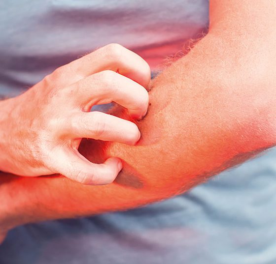 juckreiz_urtikaria_istock-968972234