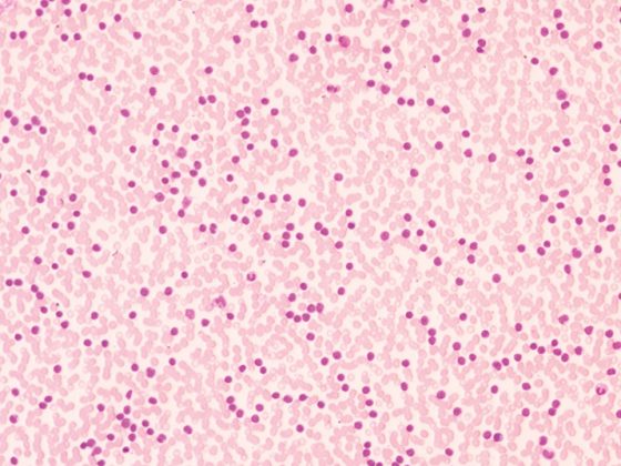 leukaemie_akut_myeloisch_istock-1062455072