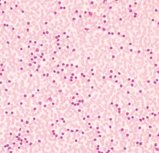 leukaemie_akut_myeloisch_istock-1062455072