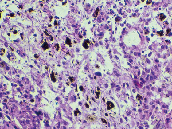 melanom_biopsie-istock-908464974