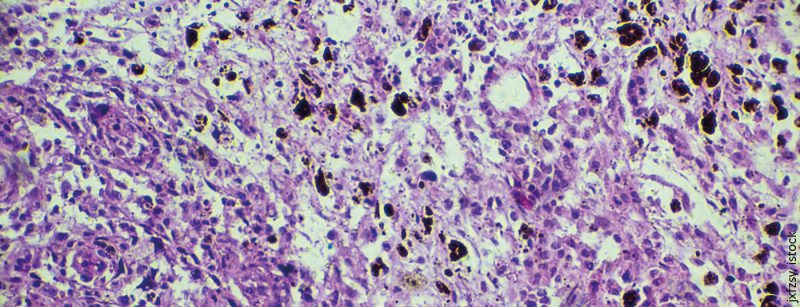 melanom_biopsie-istock-908464974