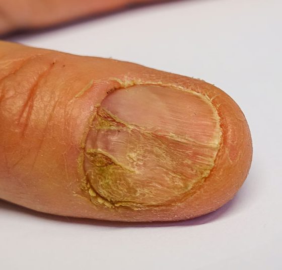 nagelpsoriasis_istock-1199610146
