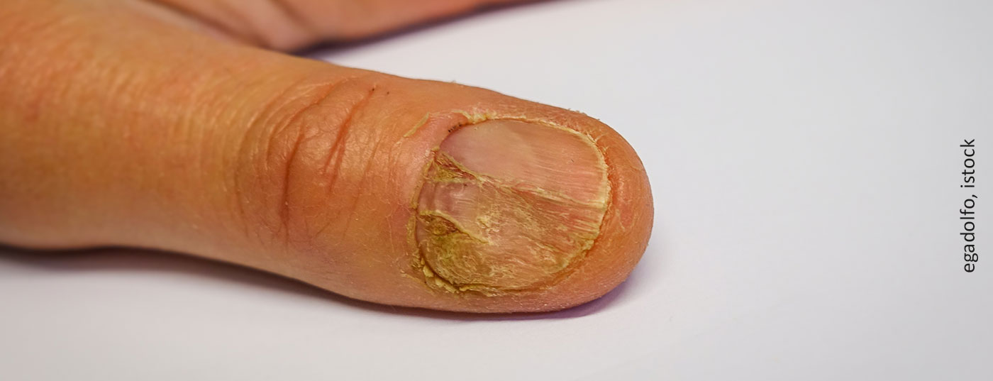 nagelpsoriasis_istock-1199610146