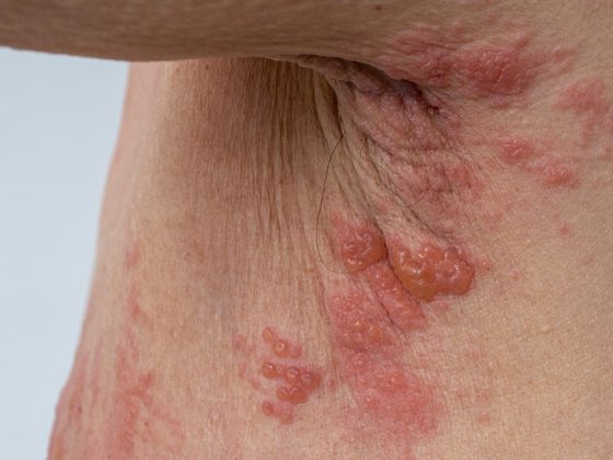 guertelrose_herpeszoster_istock-1336259341