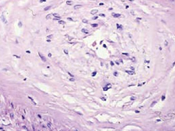 systemische_sklerose