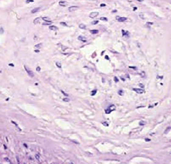 systemische_sklerose