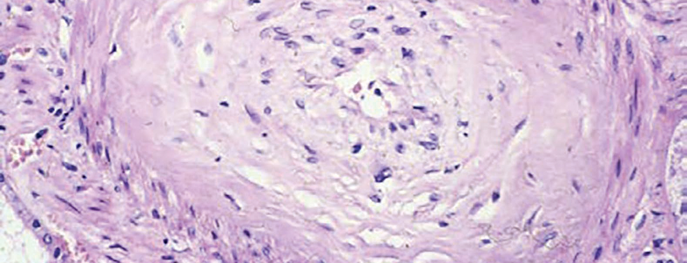 systemische_sklerose