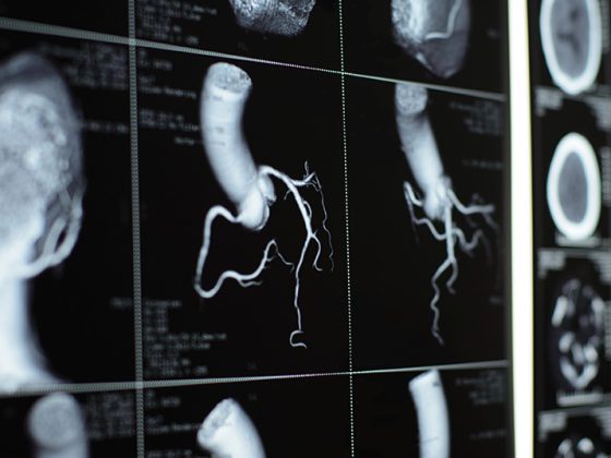 ct-herz_istock-499515413