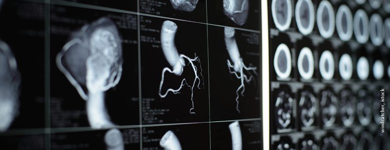 ct-herz_istock-499515413