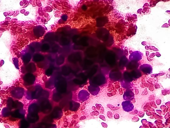 lungenkrebs_istock-1415955116