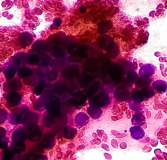 lungenkrebs_istock-1415955116