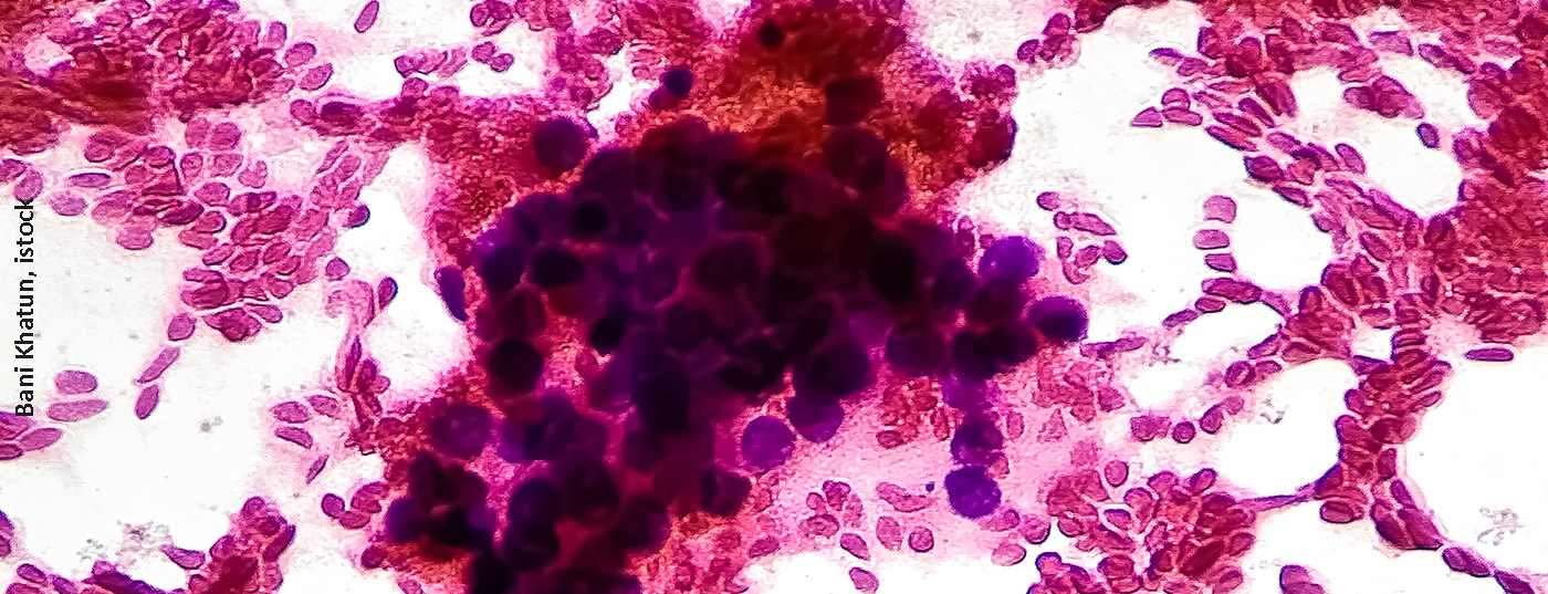 lungenkrebs_istock-1415955116