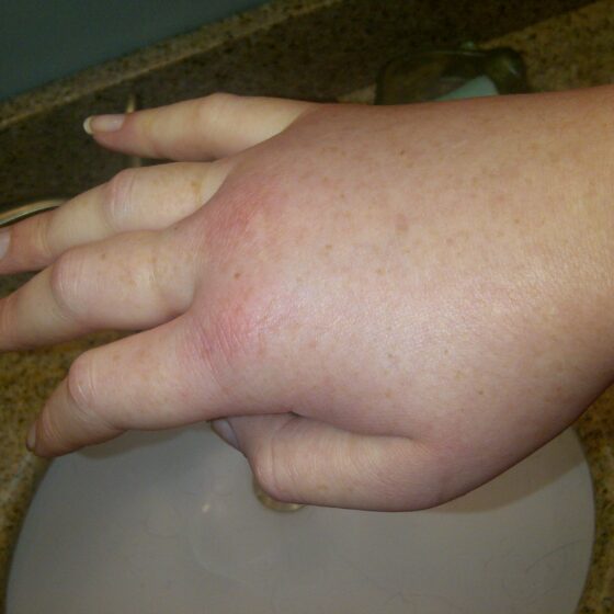 Swollen right hand in a female patient during a hereditary angioedema attack