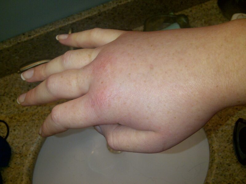 Swollen right hand in a female patient during a hereditary angioedema attack